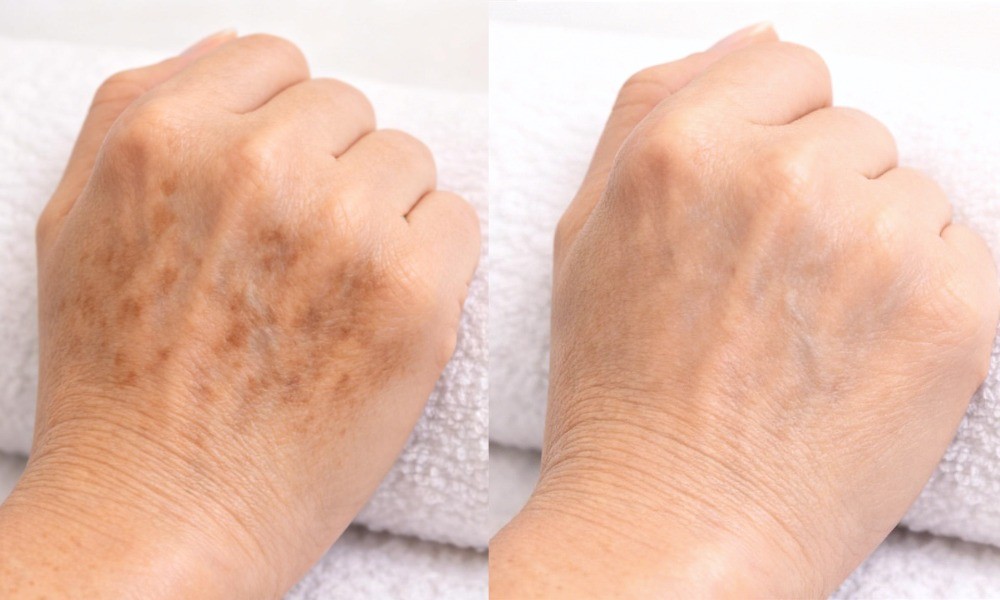 Dark Spot Diminisher