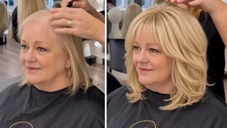 Glokore Hair Regrowth Cap before and after