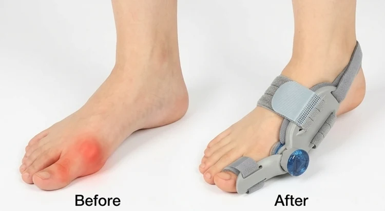 Hallux Bunion Corrector